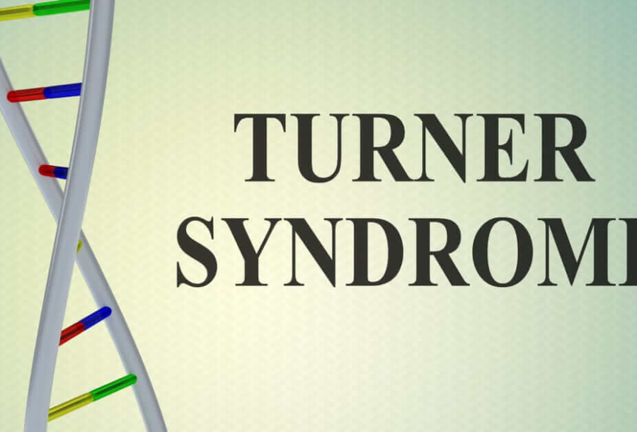 TURNER SENDROMU